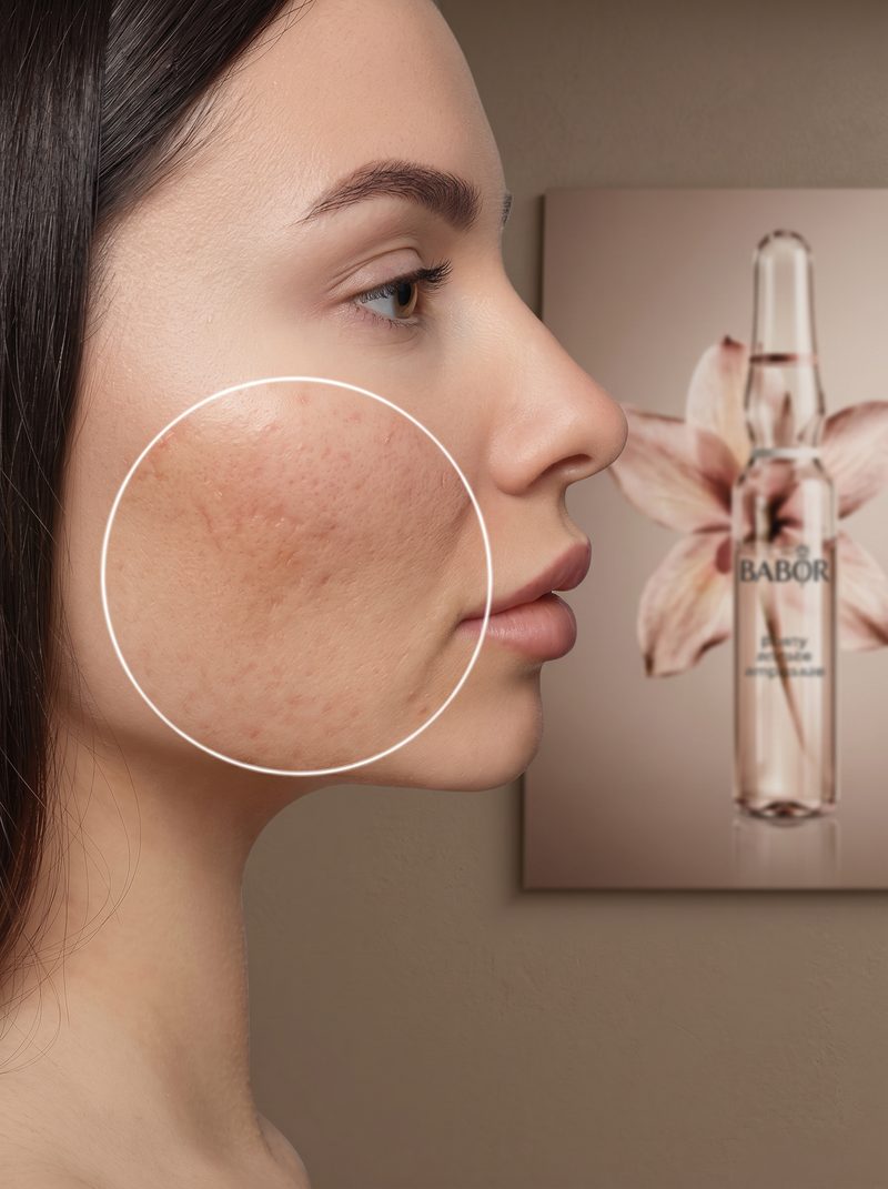 Klärende BABOR-Gesichtspflege für unreine und zu Unreinheiten neigende Haut bei Beauty Boulevard Frankenthal – auch für Kund:innen aus Ludwigshafen, Worms und Mannheim