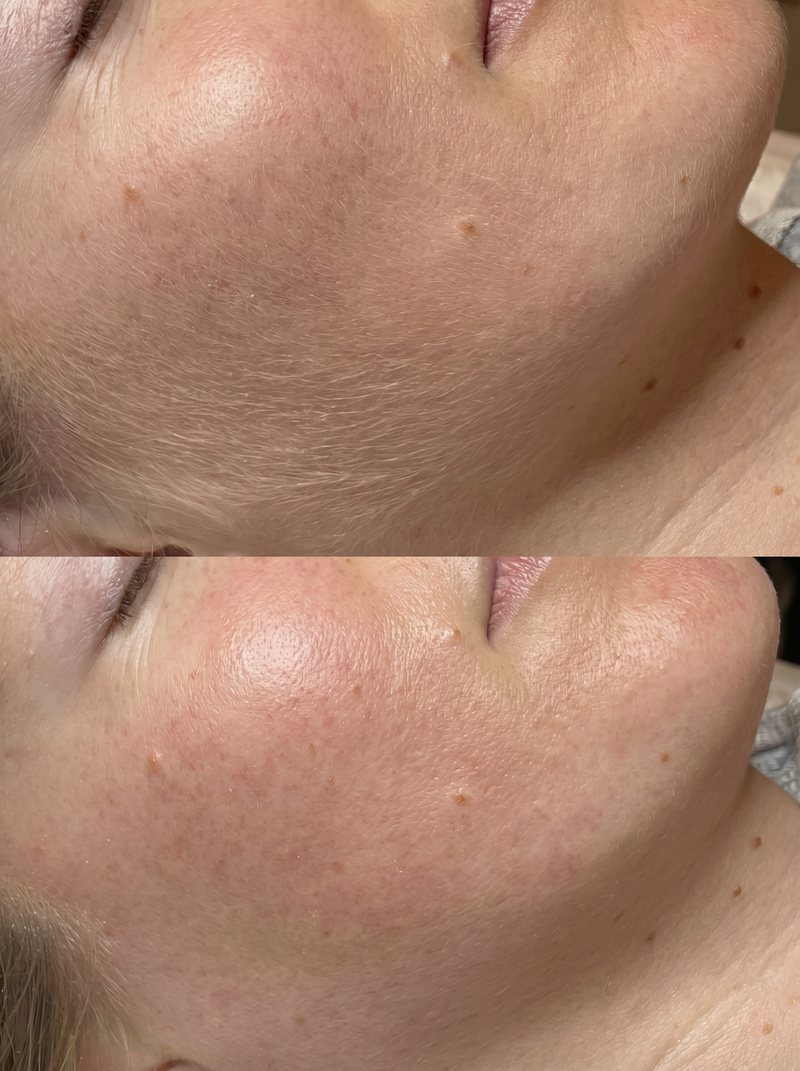 Dermaplaning Vorher-Nachher: glattere, strahlendere Haut nach dem sanften Klingen-Peeling bei Beauty Boulevard Frankenthal