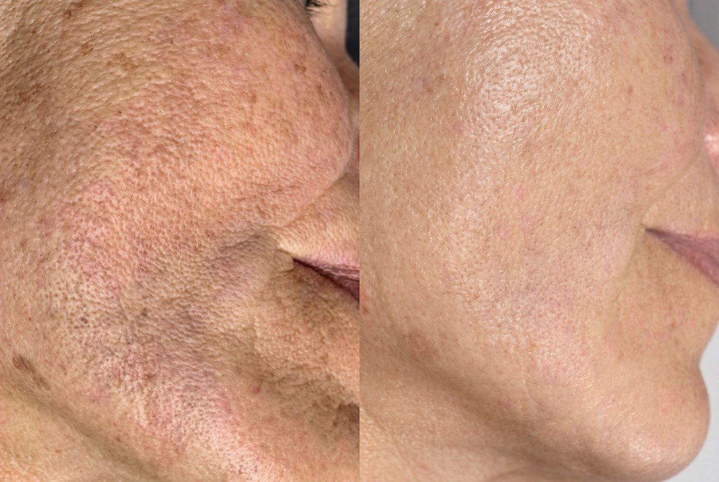 Fruchtsäurepeeling Vorher-Nachher: feineres, gleichmäßigeres Hautbild bei Beauty Boulevard Frankenthal