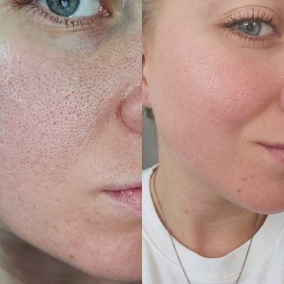 Microneedling-Ergebnis: feineres Hautbild und sichtbar verfeinerte Poren – Beauty Boulevard Frankenthal